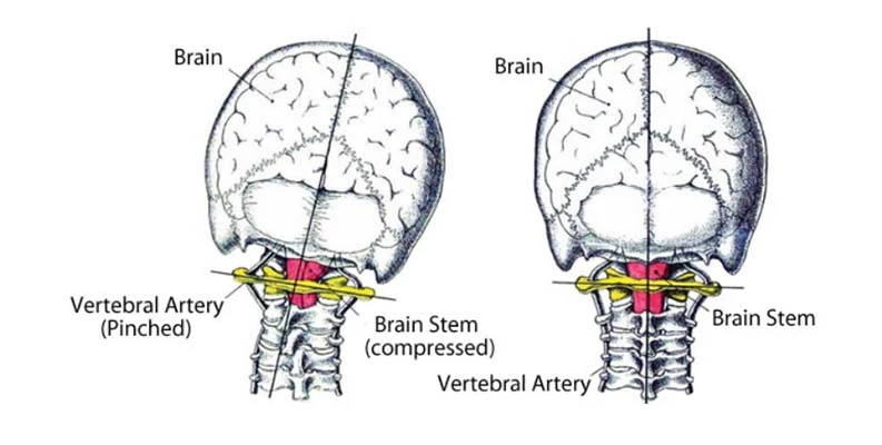 Chiropractic Sebastopol CA Toggle Recoil Method